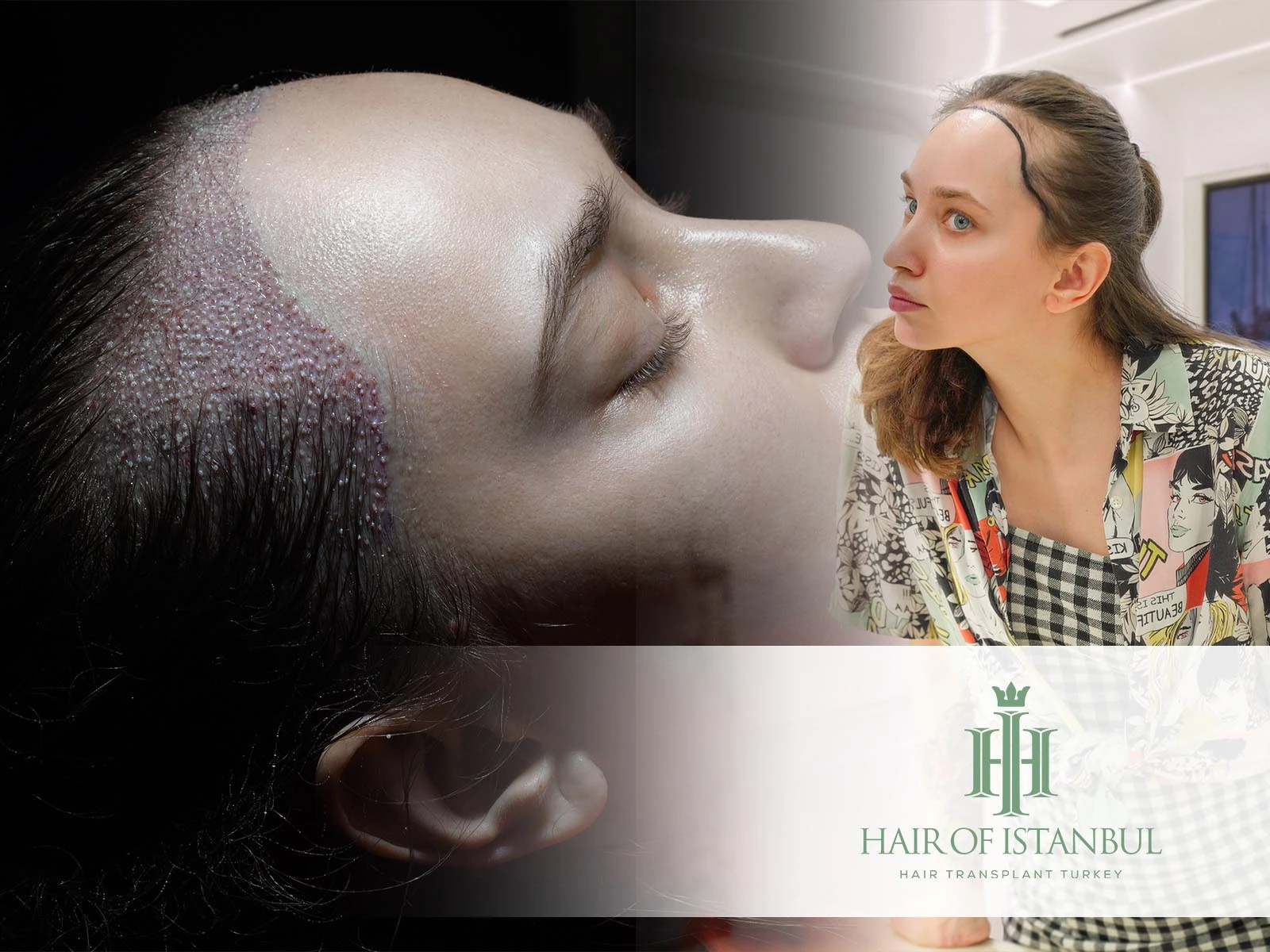Hair Implants for Women: Restore Confidence with Turkish Excellence