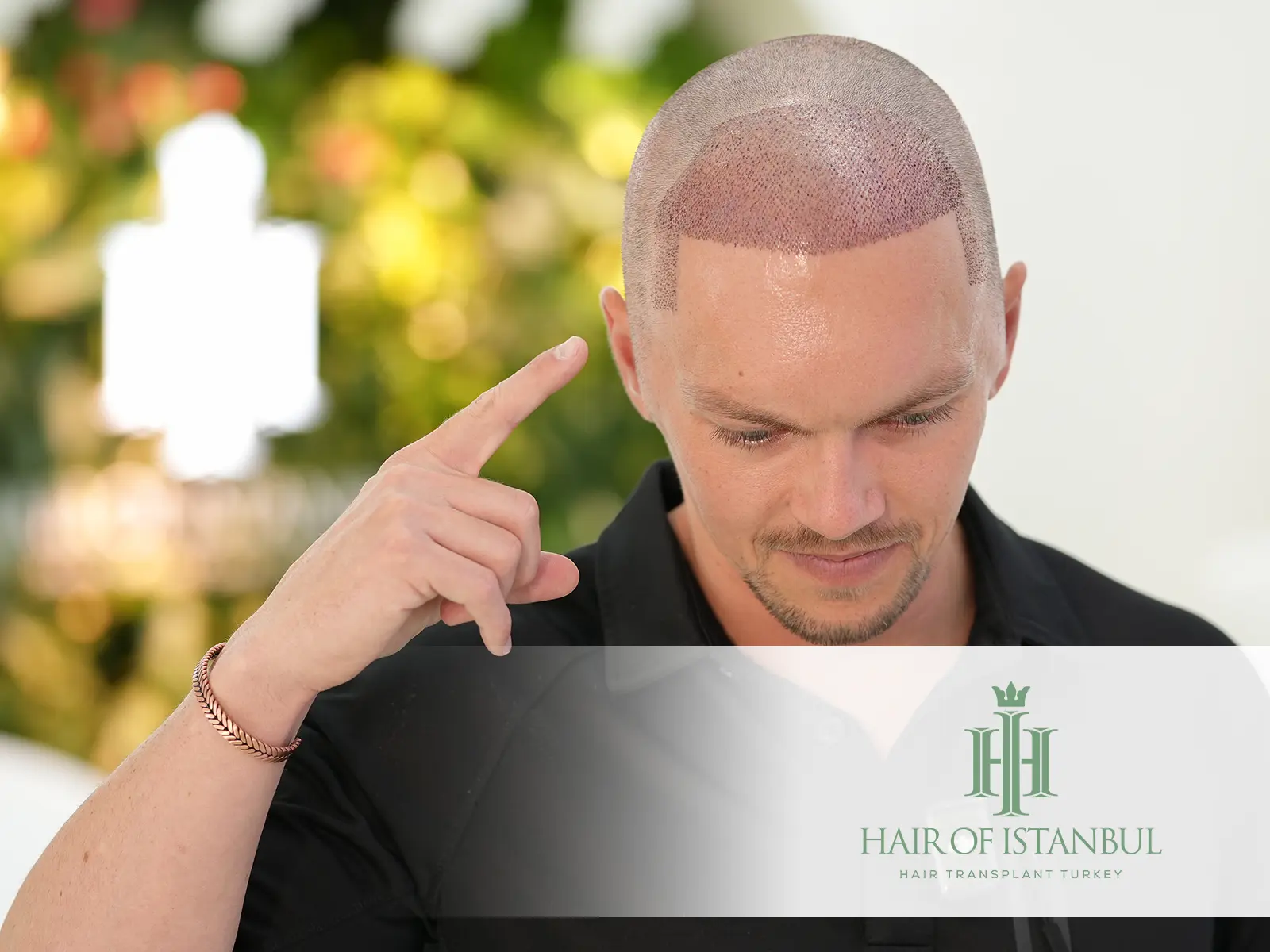 Hair Transplant Methods: Exploring the Most Effective Techniques