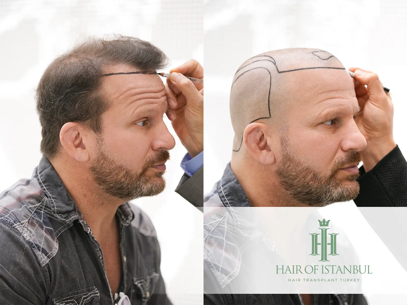 Hair Transplant Preparation: Your Complete Pre-Surgery Guide