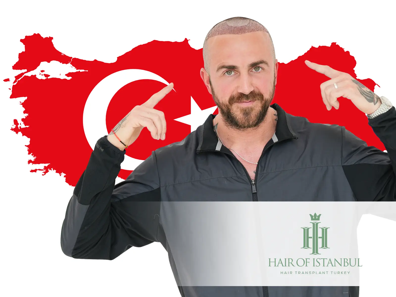 Hair Transplant Tourism in Turkey: Why It Has Become a Global Phenomenon