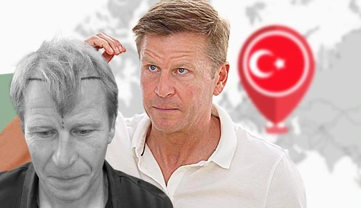 Hair Transplant Turkey vs Other Countries