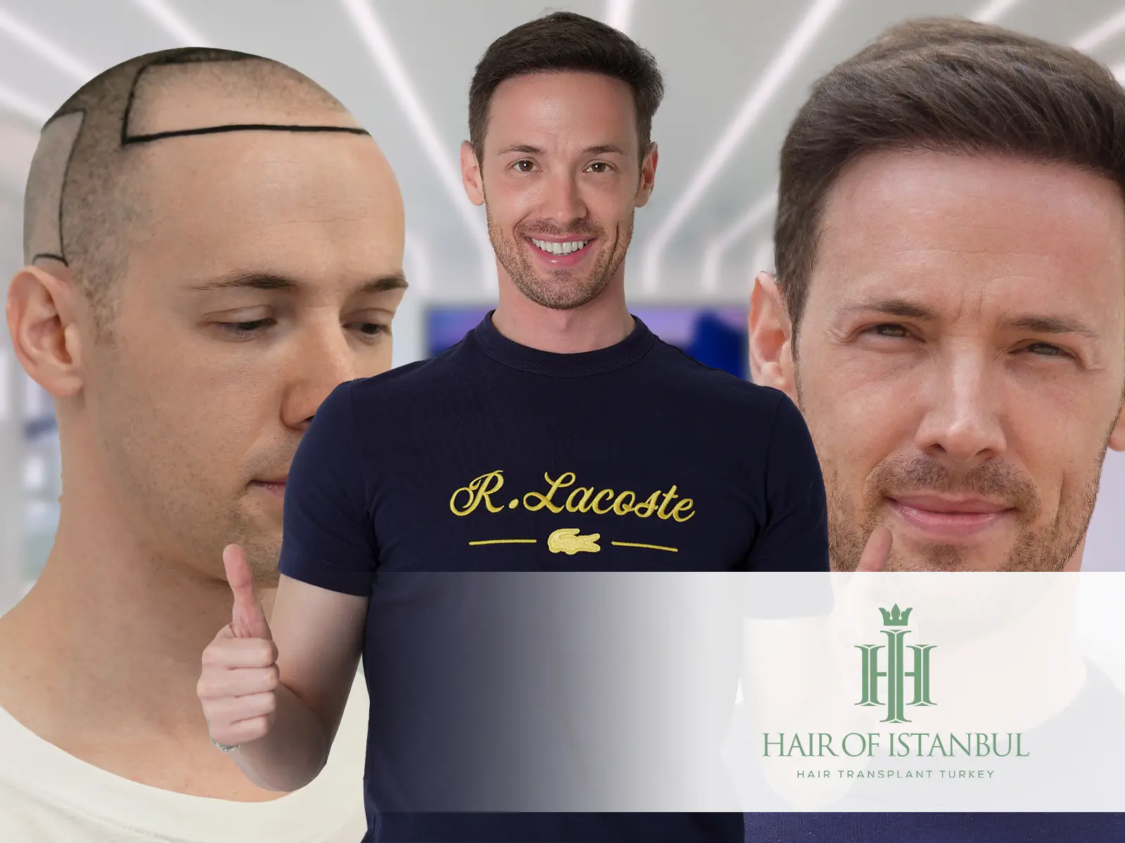 Hair Transplant and Confidence: Restoring Self-Esteem Through Transformation