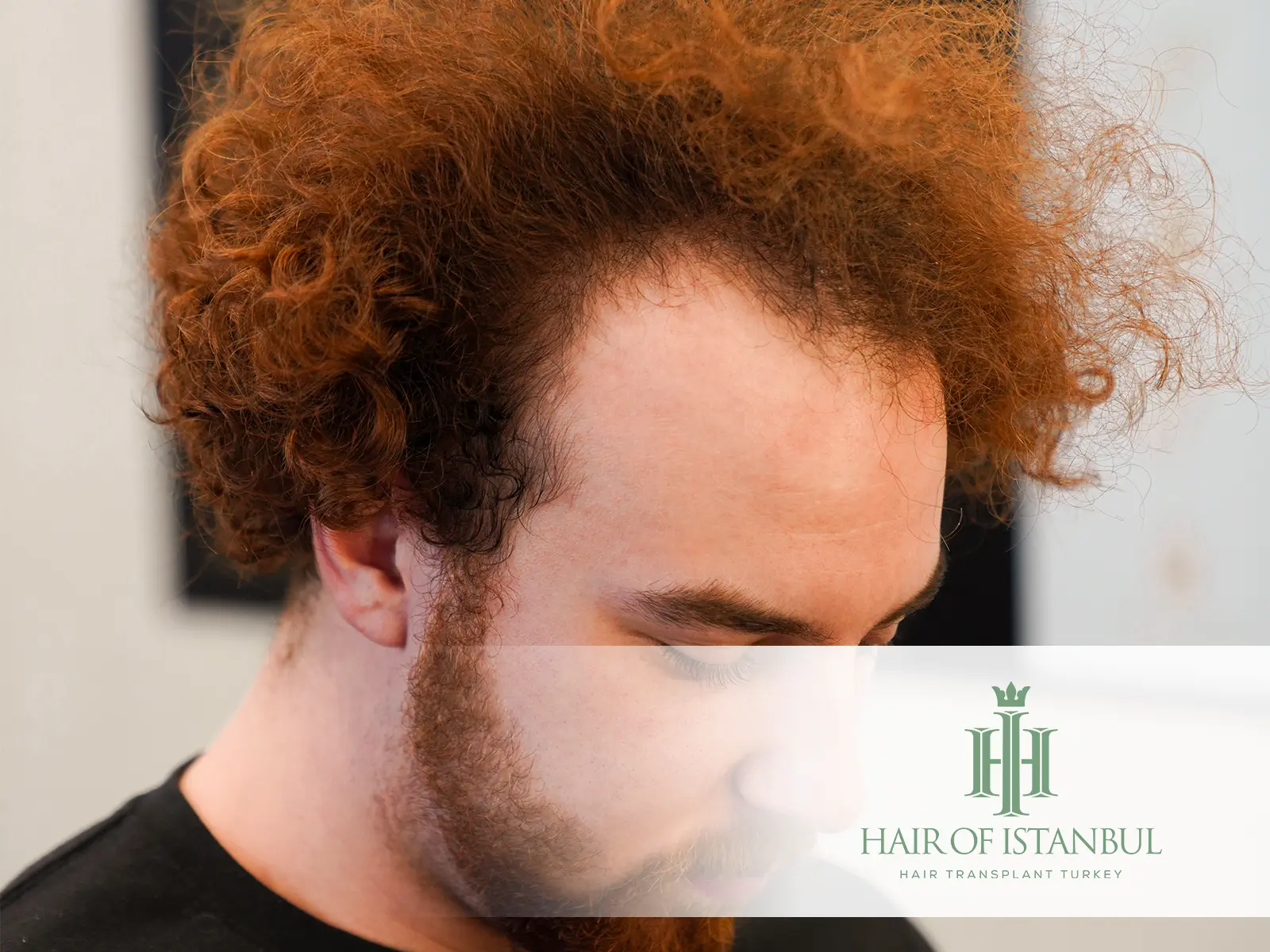Hair Transplant and Hair Color: What You Need to Know Before and After the Procedure