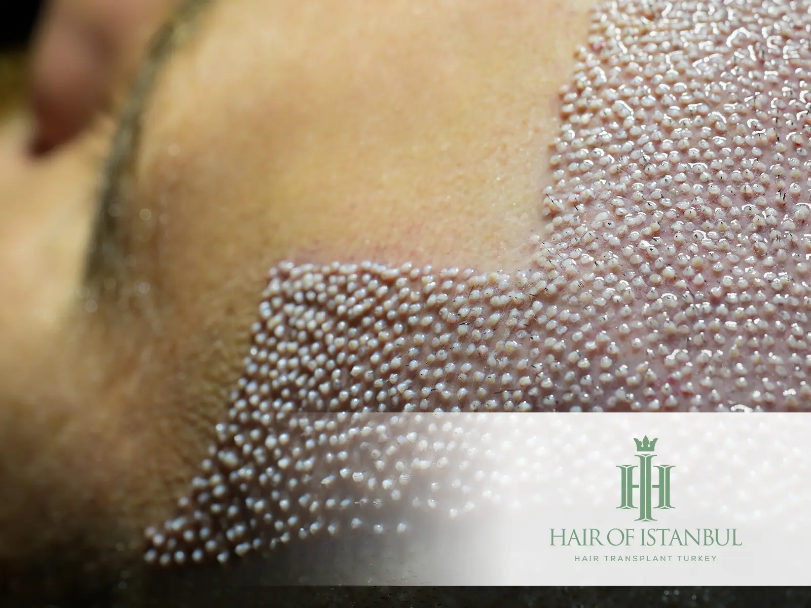 Hair Transplant and Hair Tissue Analysis: The Key to Accurate Hair Restoration