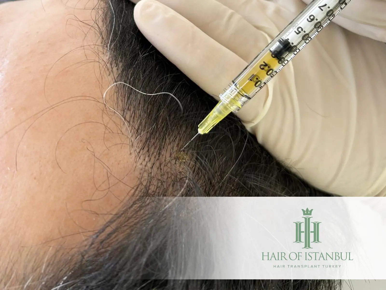 Hair Transplant and PRP Therapy: The Combined Approach for Hair Regrowth