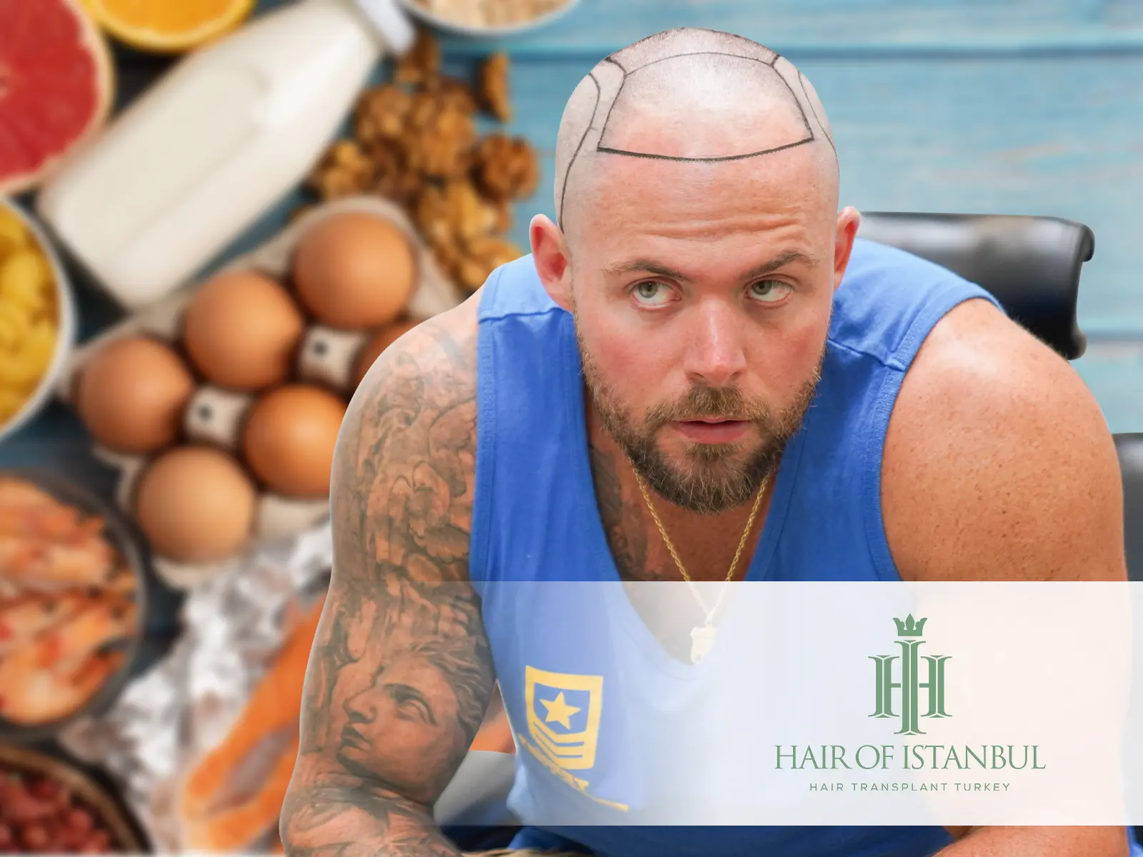 Hair Transplantation and Nutrition: The Vital Connection for Hair Growth