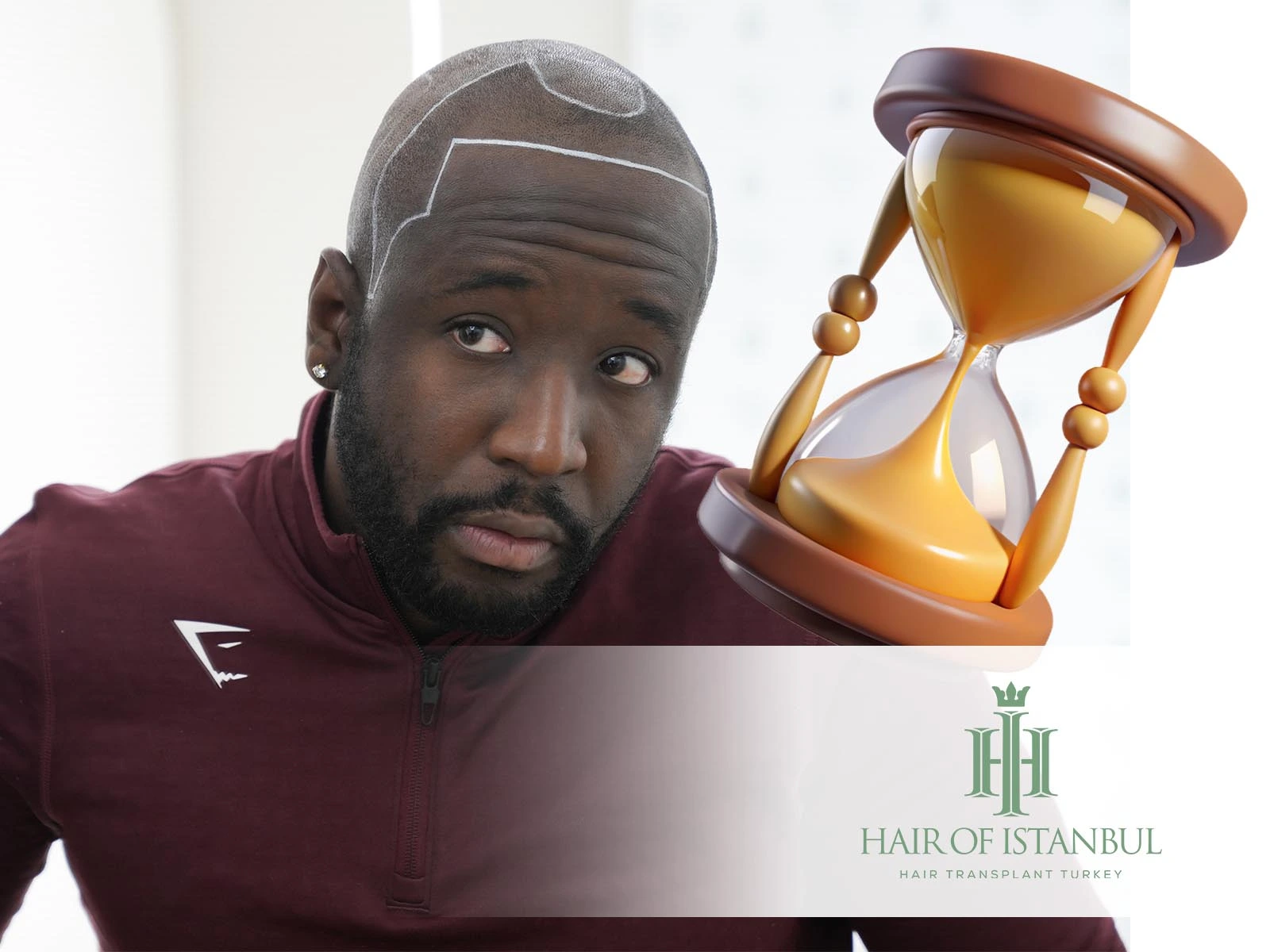 How Long Do Hair Implants Last and Why Quality Matters More Than You Think
