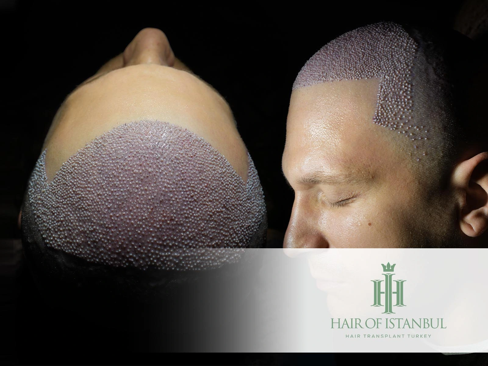 How Much Are Hair Implants? Understanding the Real Investment in Hair Restoration