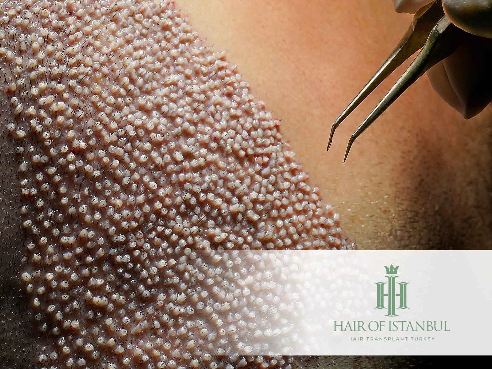 How Much Is Hair Implant Surgery and Why Hair of Istanbul Leads the Industry