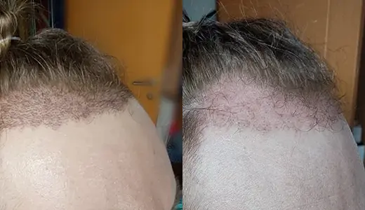 How to Identify Shock Hair Loss