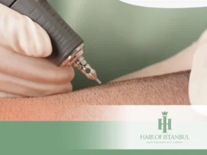 How to Reduce Transection Rate in FUE Effective Methods for Higher Success