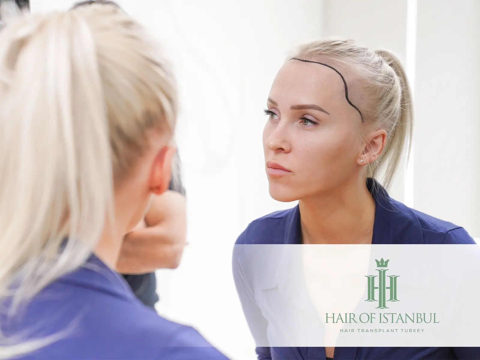 Impact of Female Hair Transplant on Social Life: A Confidence Boosting Journey
