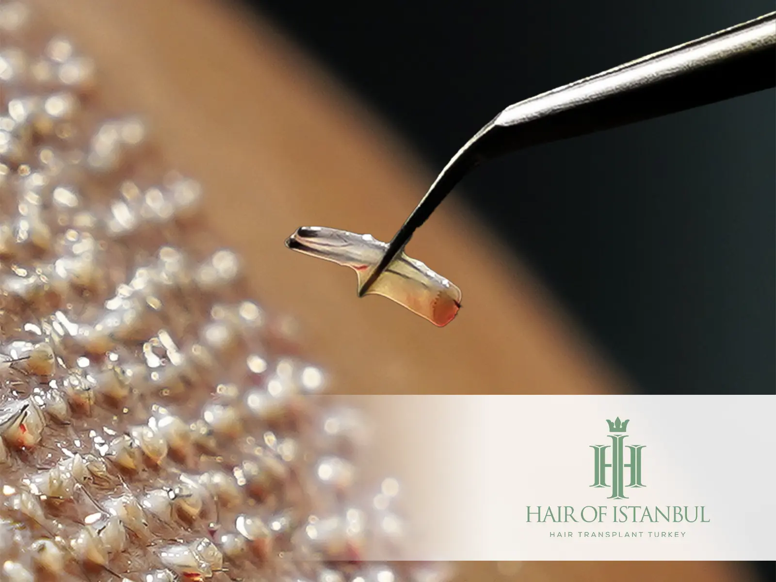 Innovations in Hair Transplant Technology: Transforming Hair Restoration