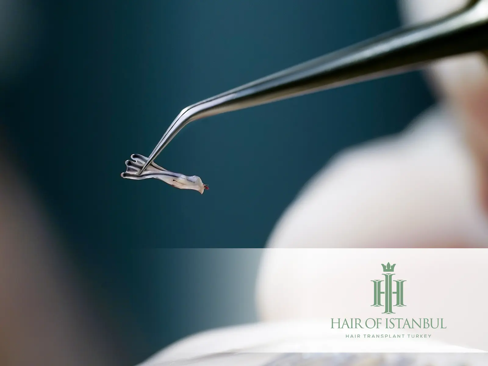 Innovative Graft Placement in Hair Transplant: Redefining Natural Results