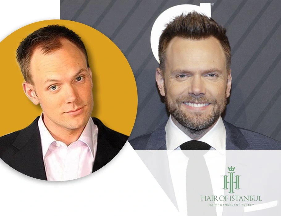 Joel McHale Hair Implants: A Closer Look at the Transformation