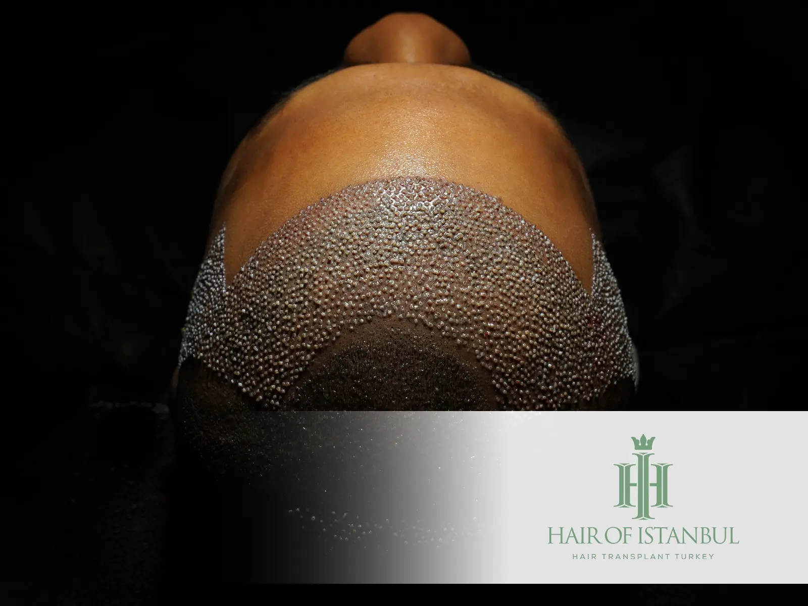 Micro Hair Transplant Techniques: Natural Results with Modern Solutions