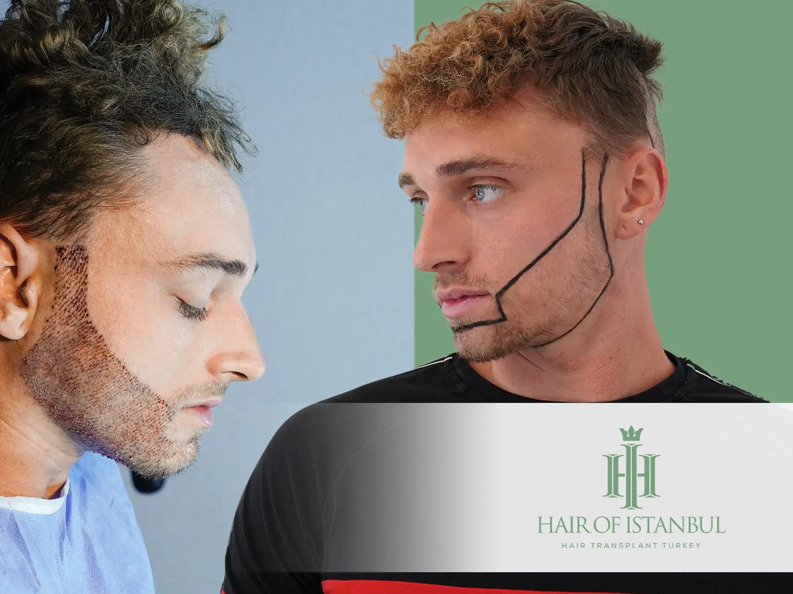 Minimal Scar Beard Transplant Techniques: Natural Look and No Visible Scars