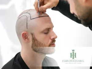 Receding Hairline: Complete 2025 Guide to Causes, Diagnosis, and Hair Transplant Solutions 3 Natural Hairline in Hair Transplant The Key to a Realistic Look