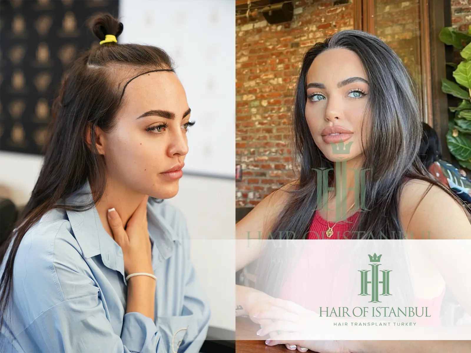 Post Hair Transplant Skin and Hair Harmony for Women: A Gentle Recovery Journey