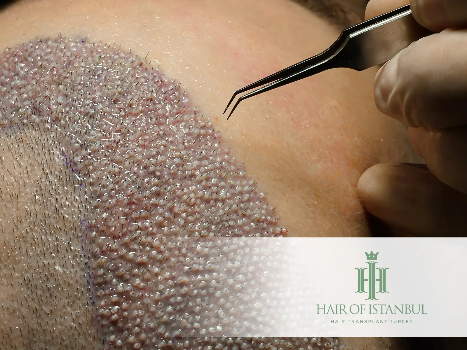 Pre-Hair Transplant Anticoagulants: What You Need to Know Before Surgery