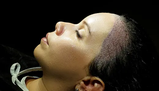 Prioritizing Scalp Comfort in the Healing Stage