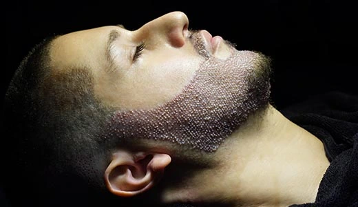 Procedure and Recovery Process