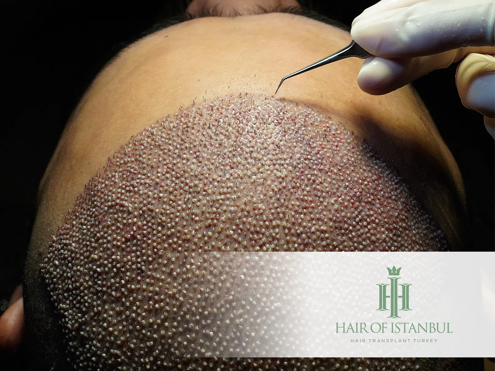 Questions to Ask Before Hair Transplant: Everything You Must Know