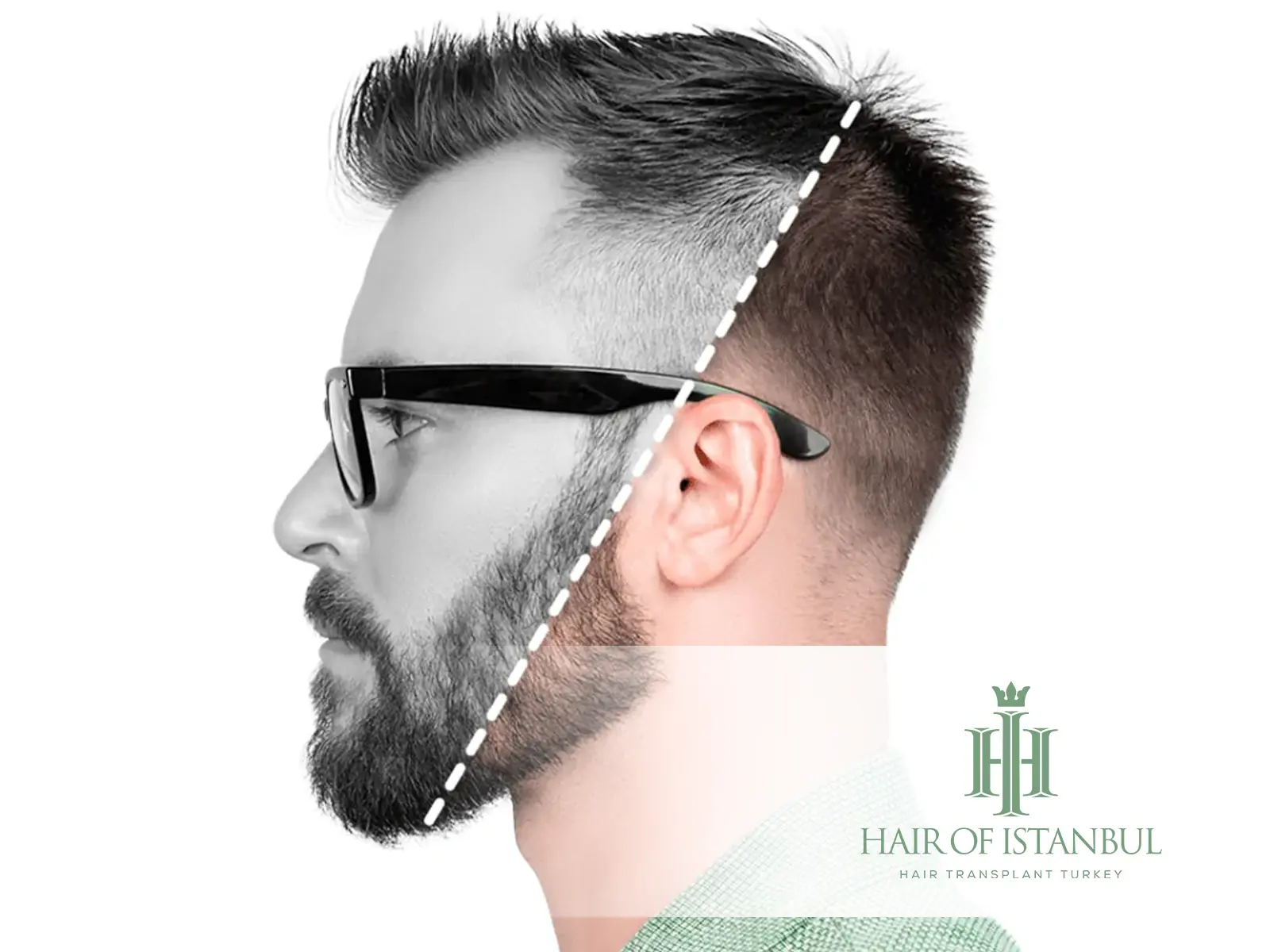 Scalp Micropigmentation: Natural Solution for Hair Density