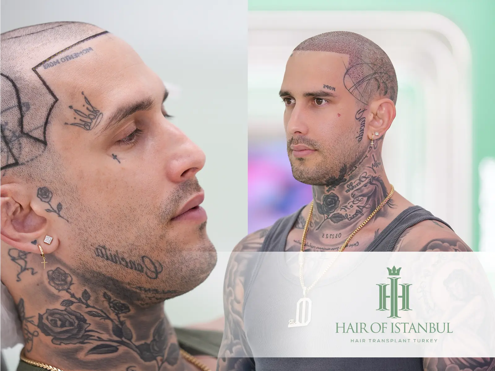 Temple Peak Hair Transplant Strategies: Achieve Perfect Hairline Framing