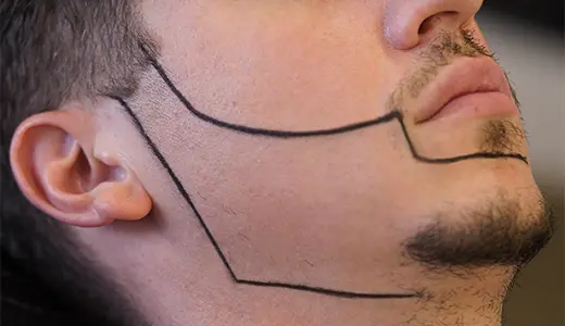 The Demand for Scar Free Beard Transplants