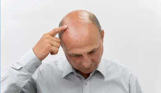 The Link Between Hair Loss Progression and Age