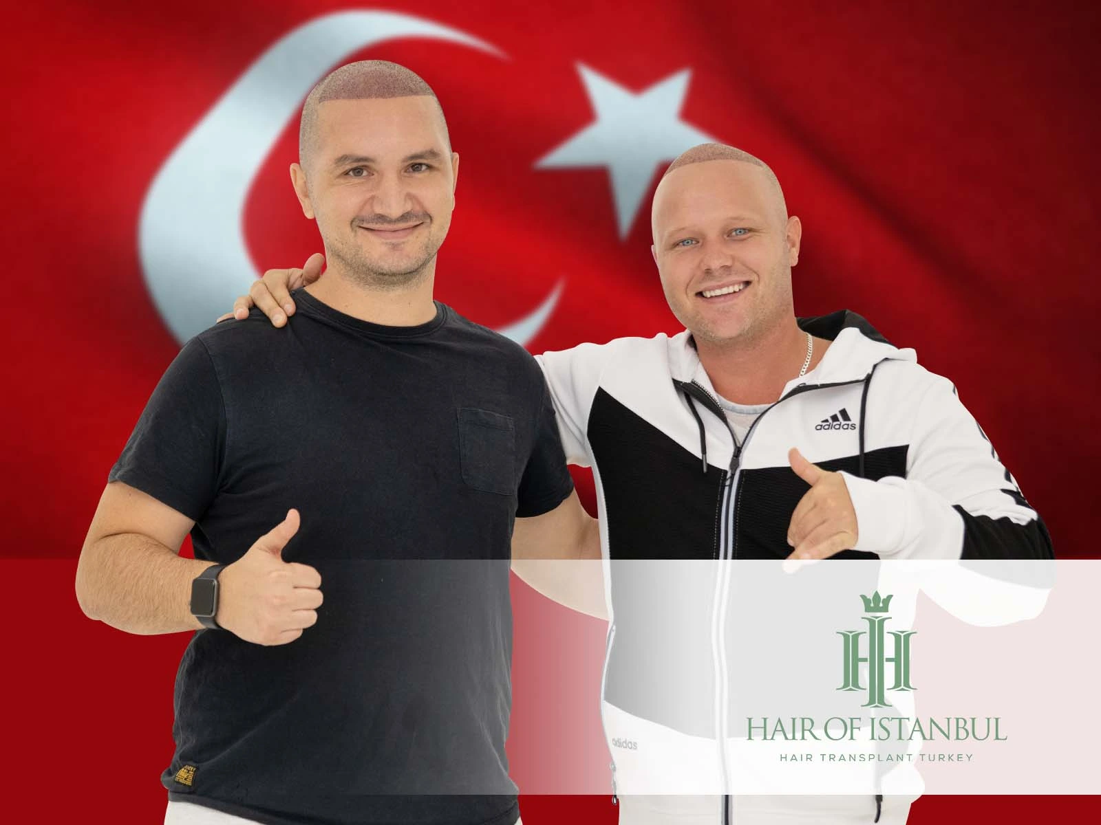 Turkish Hair Implants Redefining Hair Restoration Excellence
