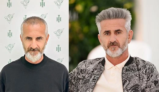 Understanding the Longevity of Hair Implants