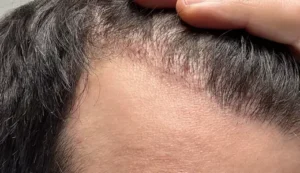Hair Transplant Side Effects: Swelling, Redness, and Shock Loss Explained (2025 Guide) 3 What Is Shock Hair Loss After Transplant