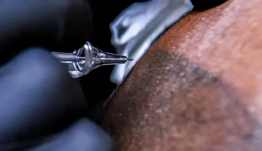 What is Scalp Micropigmentation