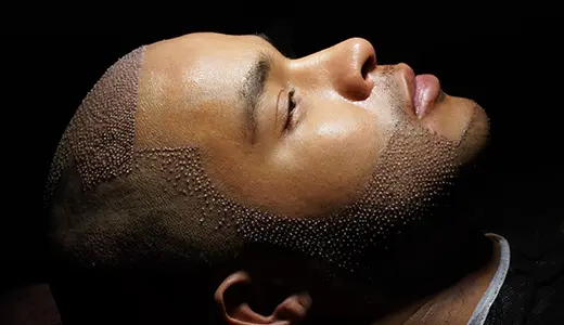 Who Benefits from a Personalized Beard Transplant