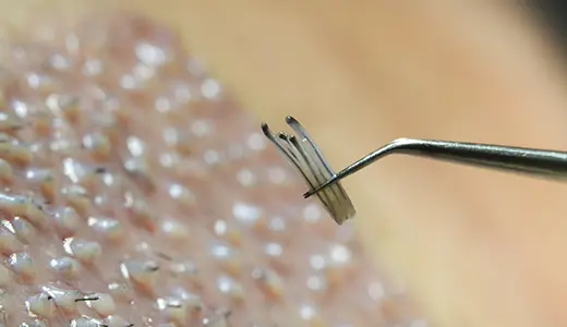Why Does Itching Occur After Hair Transplantation