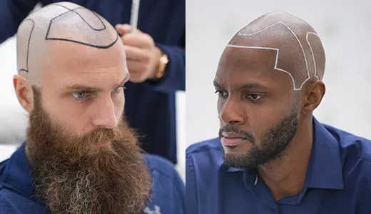 Why Face Shape Matters in forehead size