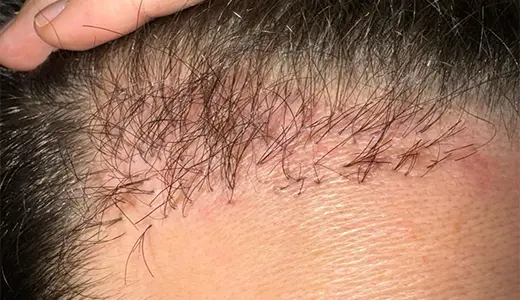 Why Patients Seek a Revision Hair Transplant