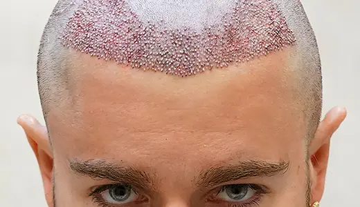 Why Scalp Hygiene Matters After Hair Transplant