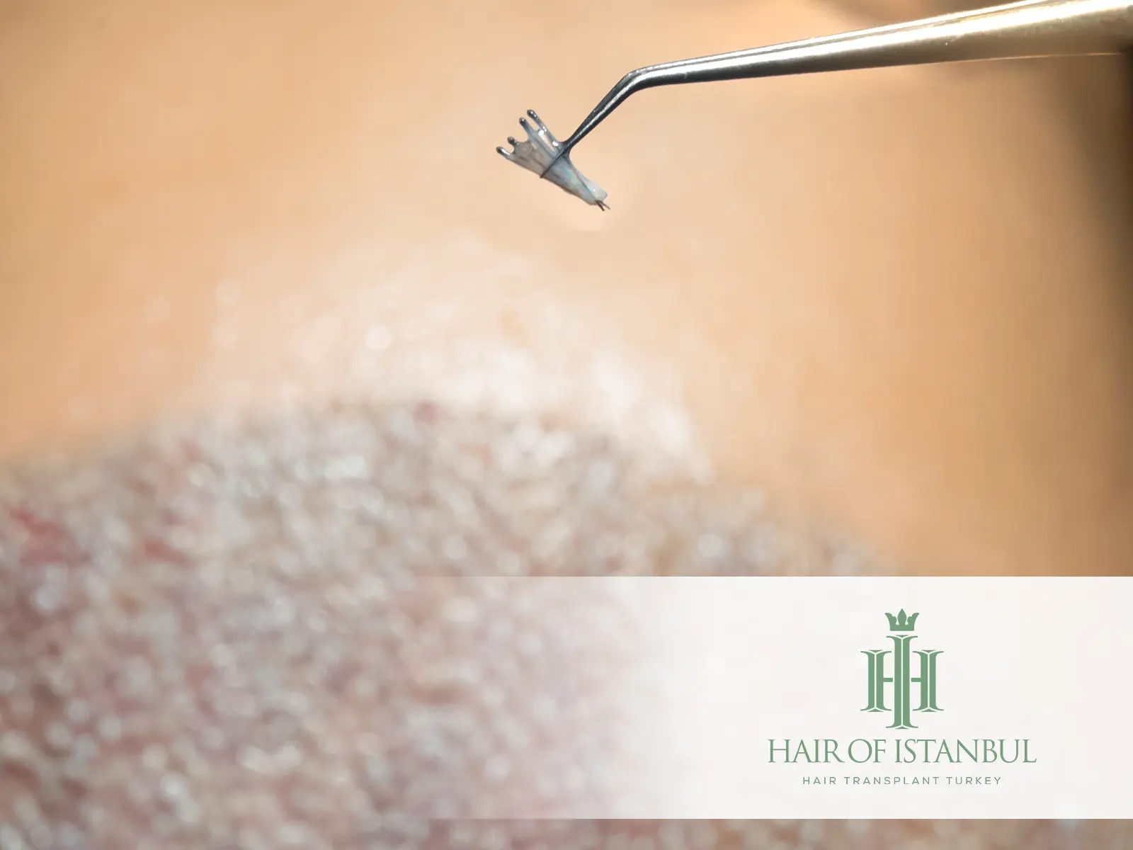 HypoThermosol for Graft Preservation: Healthier Hair Transplant Outcomes