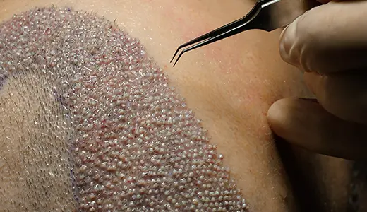 Minimizing Graft Trauma and Increasing Survival Rates