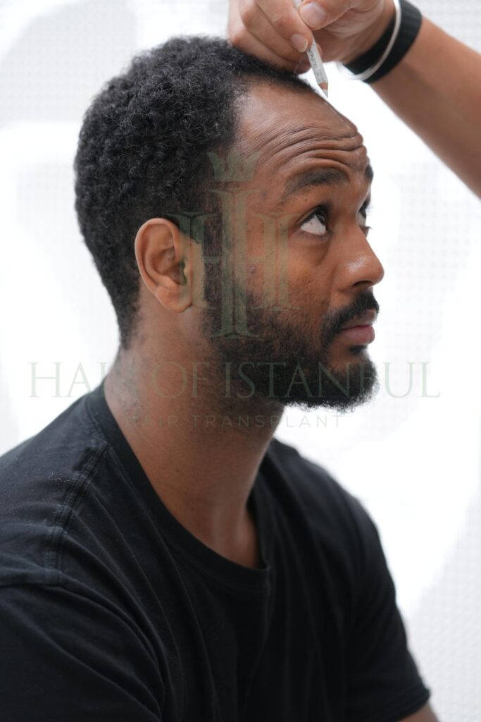 afro american hair transplant