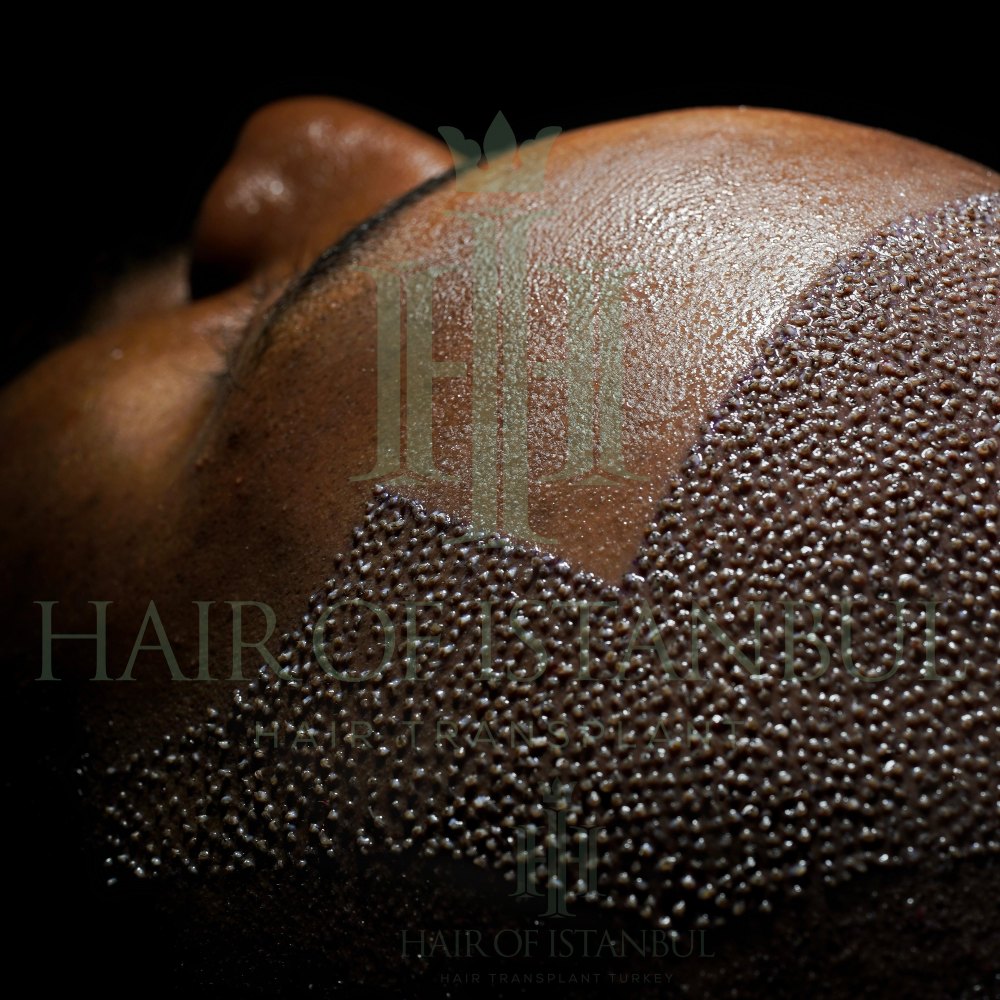 black hair transplant