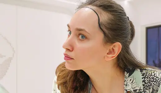Female Hair Transplant and Restoration Why Women Experience Hair Loss