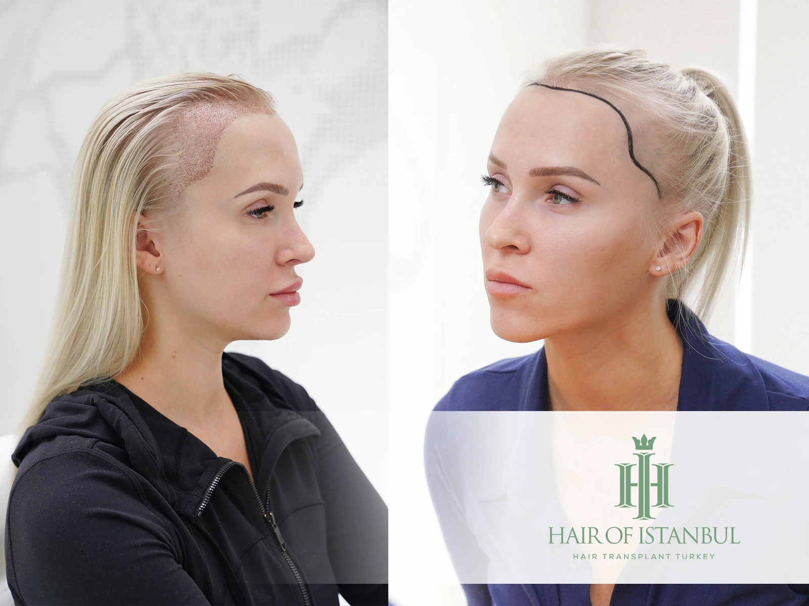 Female Hair Transplant and Restoration