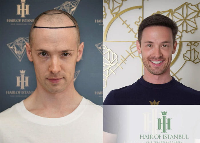 Before and After Results hair of transplant g1 HairOfIstanbul