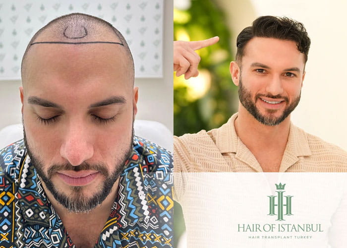 Hair transplant procedure in Turkey for natural hair restoration.