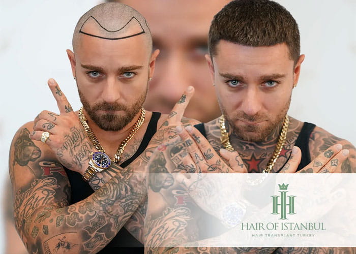 High-quality hair transplant procedure in Turkey with expert surgeons at Hair of Istanbul. Achieve natural-looking results and restore your confidence with our advanced hair restoration solutions.