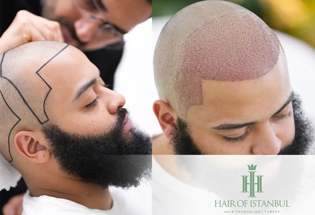 Hair Transplant in Turkey 2 hair transplant istanbul
